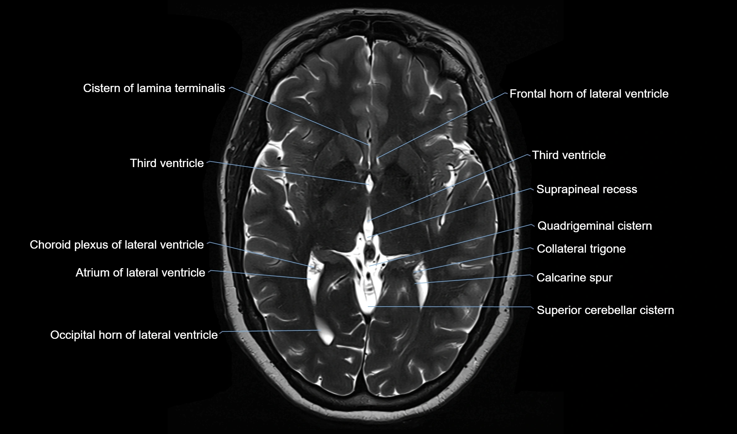 Brain cisterns  and ventricles  axial anatomy 3T MRI image-img-00001-00027.webp